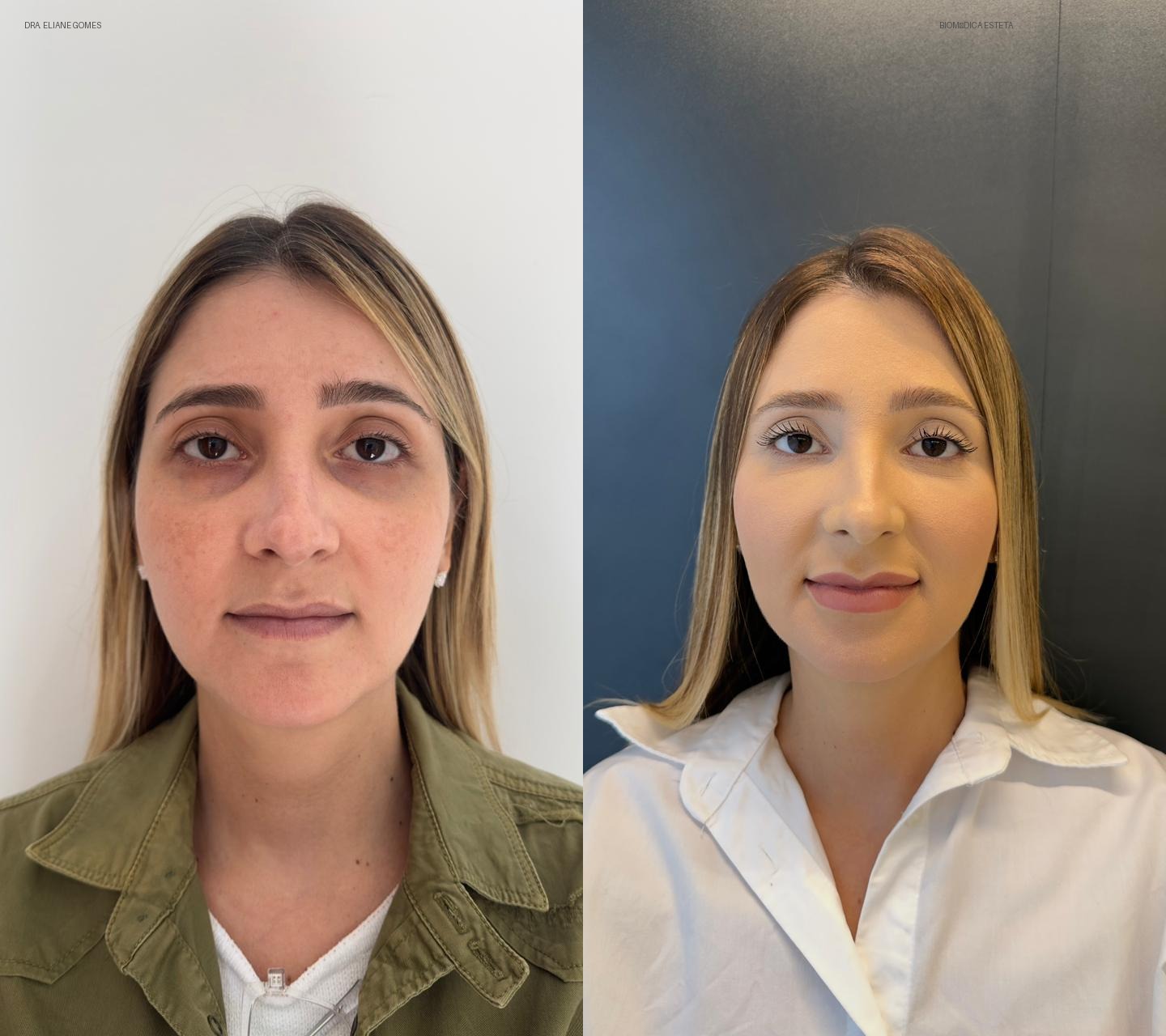 Preenchimento de olheira e labial